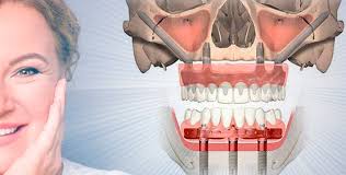 Протезирование зубов всё, что вам нужно знать Протезирование зубов всё, что вам нужно знать